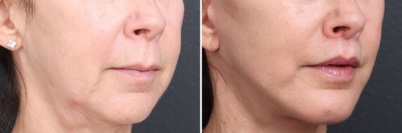 Lip Lift Before and After Photos in Princeton, NJ, Patient 22207