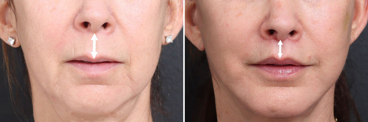 Lip Lift Before and After Photos in Princeton, NJ, Patient 22207