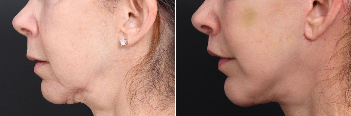 Lip Lift Before and After Photos in Princeton, NJ, Patient 22207
