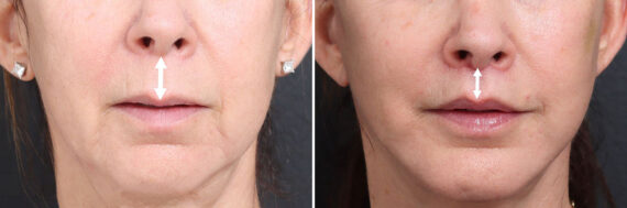 Lip Lift Before and After Photos in Princeton, NJ, Patient 22207