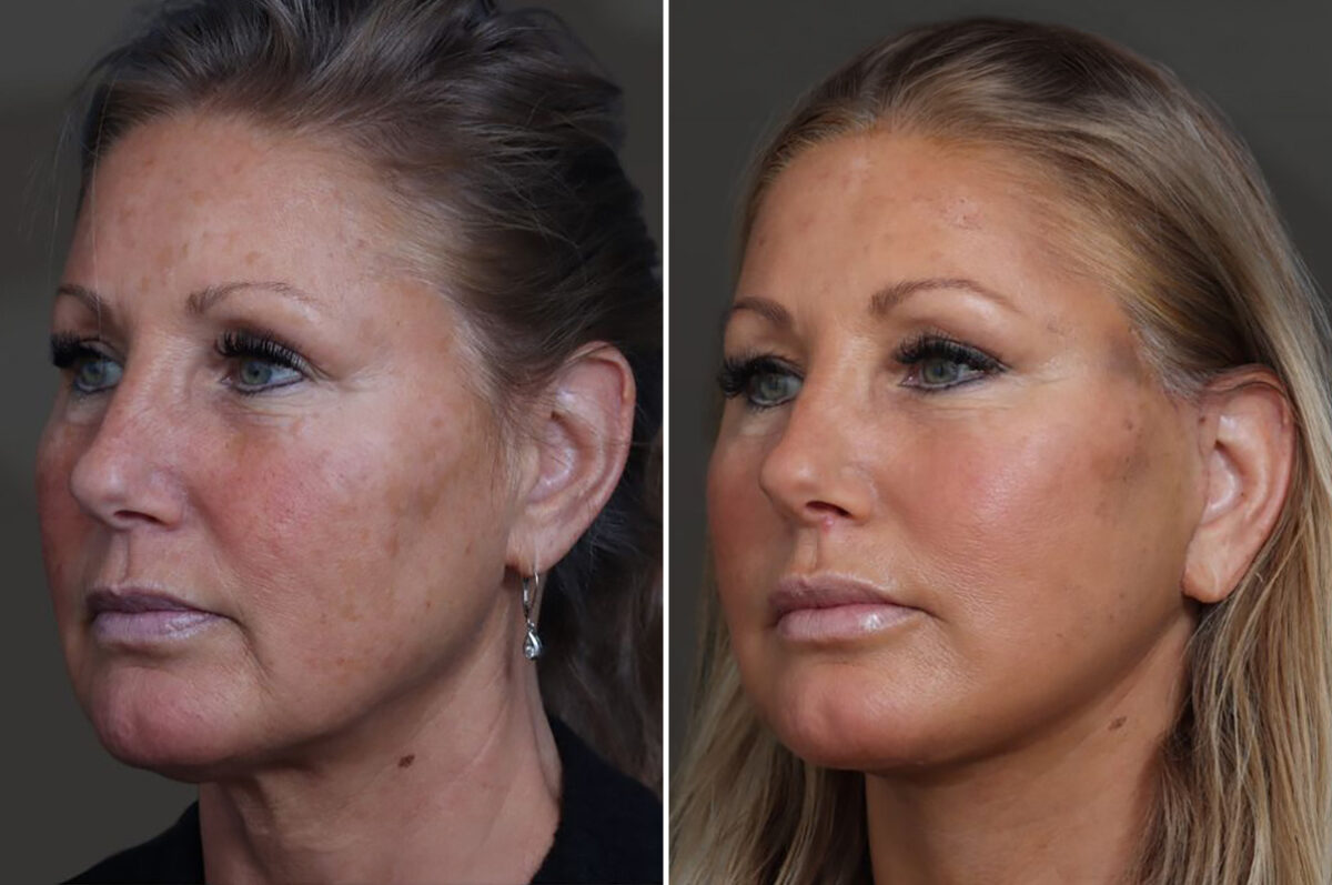 Facelift Before and After Photos in Princeton, NJ, Patient 22211