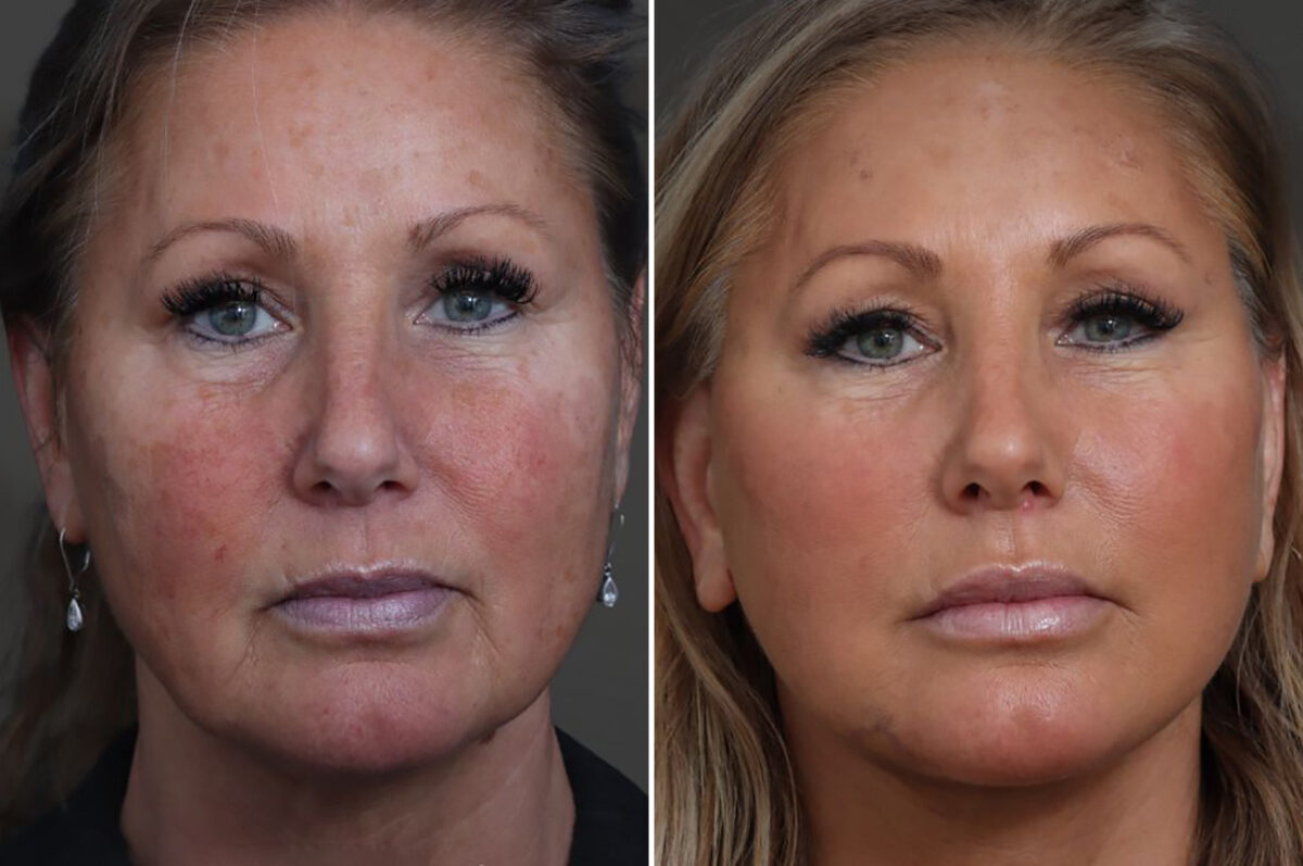 Facelift Before and After Photos in Princeton, NJ, Patient 22211