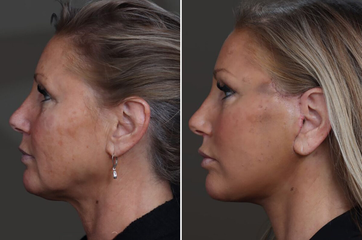 Facelift Before and After Photos in Princeton, NJ, Patient 22211