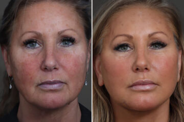 Facelift Before and After Photos in Princeton, NJ, Patient 22211
