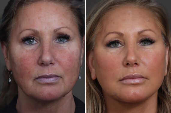 Facelift Before and After Photos in Princeton, NJ, Patient 22211