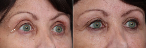 Fat Grafting Before and After Photos in Princeton, NJ, Patient 22215