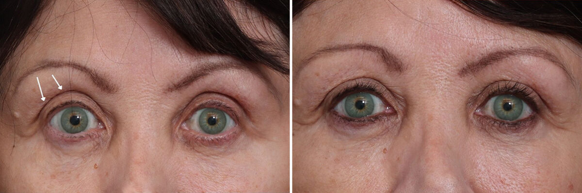Fat Grafting Before and After Photos in Princeton, NJ, Patient 22215