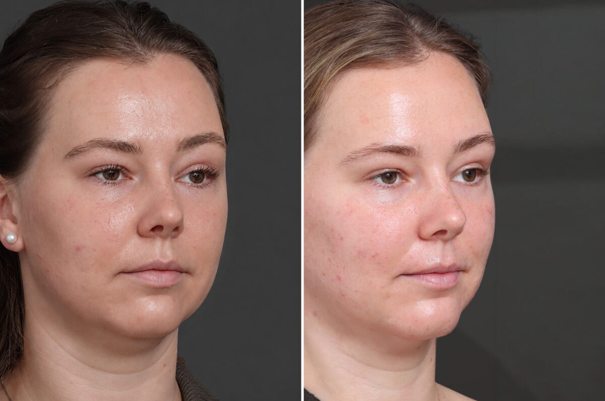 Chin Liposuction Before and After Photos in Princeton, NJ, Patient 22218