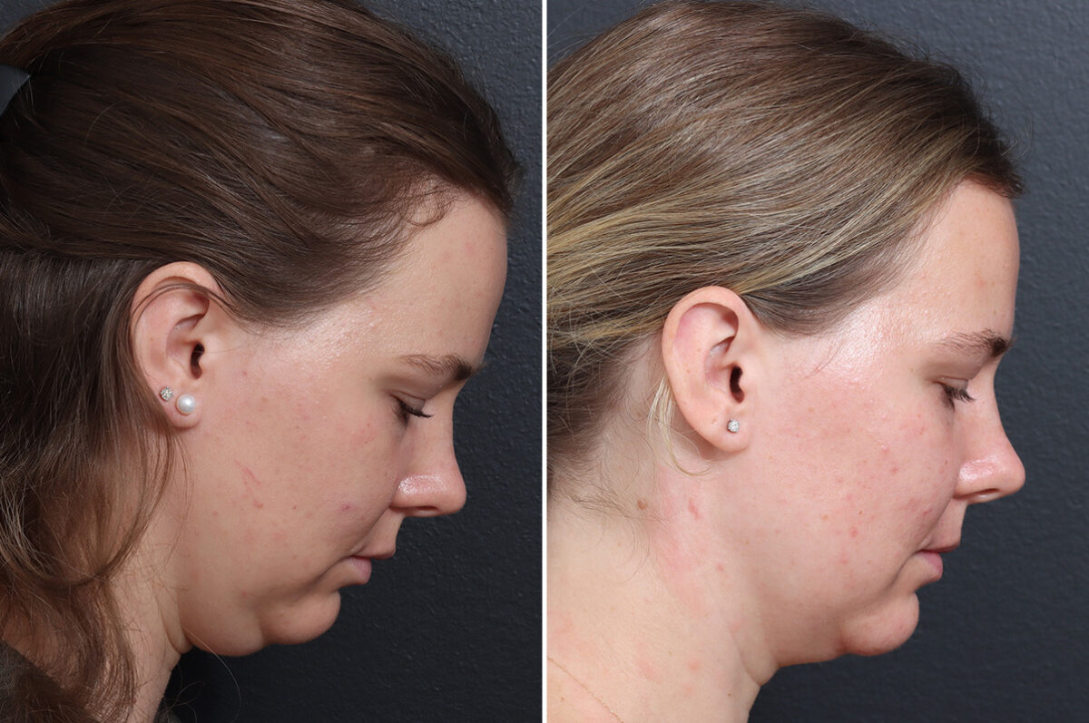 Chin Liposuction Before and After Photos in Princeton, NJ, Patient 22218