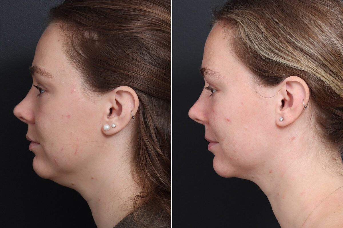 Chin Liposuction Before and After Photos in Princeton, NJ, Patient 22218