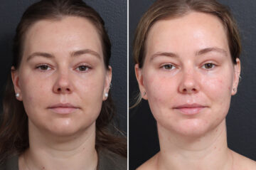 Chin Liposuction Before and After Photos in Princeton, NJ, Patient 22218