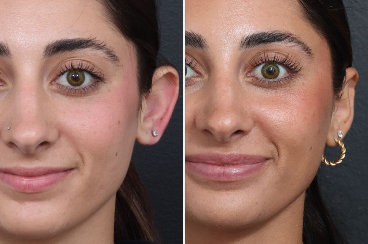 Otoplasty Before and After Photos in Princeton, NJ, Patient 22223