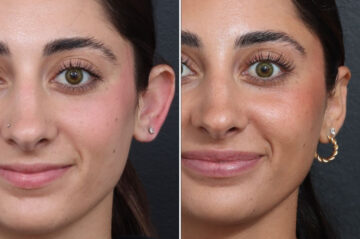Otoplasty Before and After Photos in Princeton, NJ, Patient 22223