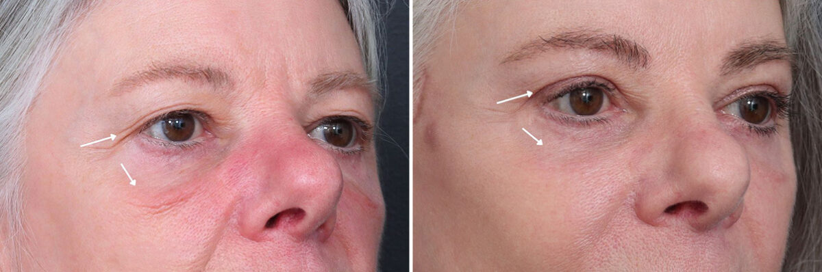 Upper and Lower Eyelid Surgery Before and After Photos in Princeton, NJ, Patient 22225
