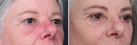 Upper and Lower Eyelid Surgery Before and After Photos in Princeton, NJ, Patient 22225