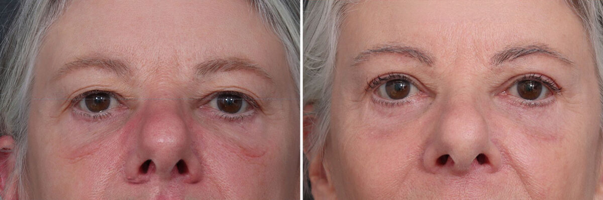 Upper and Lower Eyelid Surgery Before and After Photos in Princeton, NJ, Patient 22225