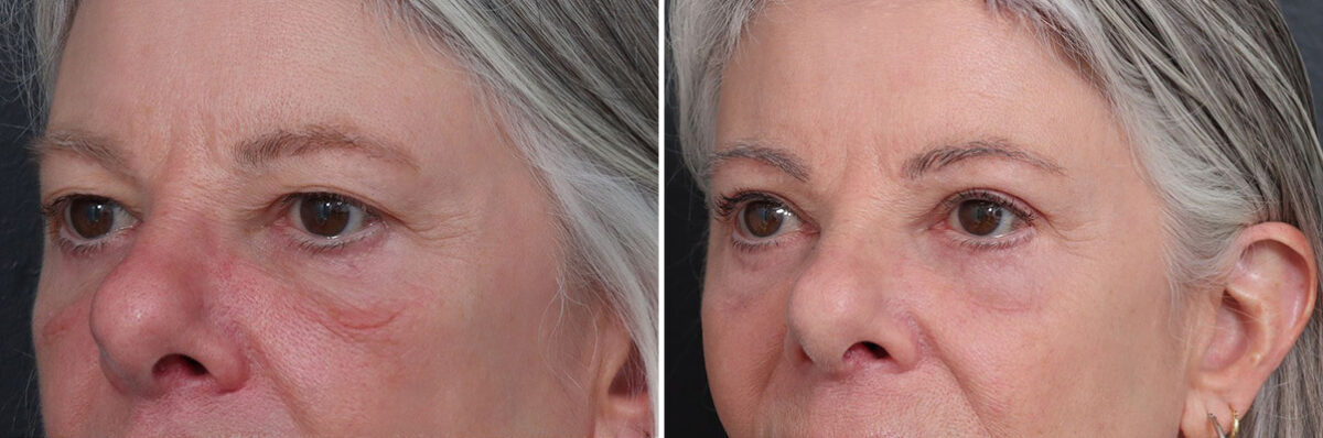 Upper and Lower Eyelid Surgery Before and After Photos in Princeton, NJ, Patient 22225