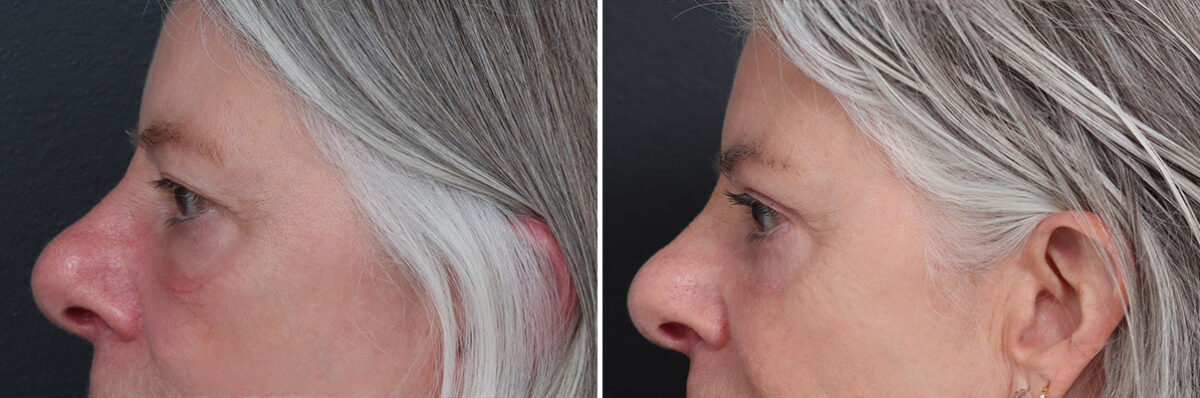 Upper and Lower Eyelid Surgery Before and After Photos in Princeton, NJ, Patient 22225