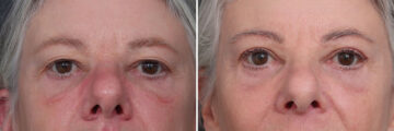 Upper and Lower Eyelid Surgery Before and After Photos in Princeton, NJ, Patient 22225