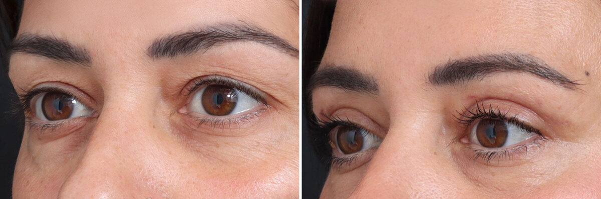 Upper Eyelid Surgery Before and After Photos in Princeton, NJ, Patient 22230