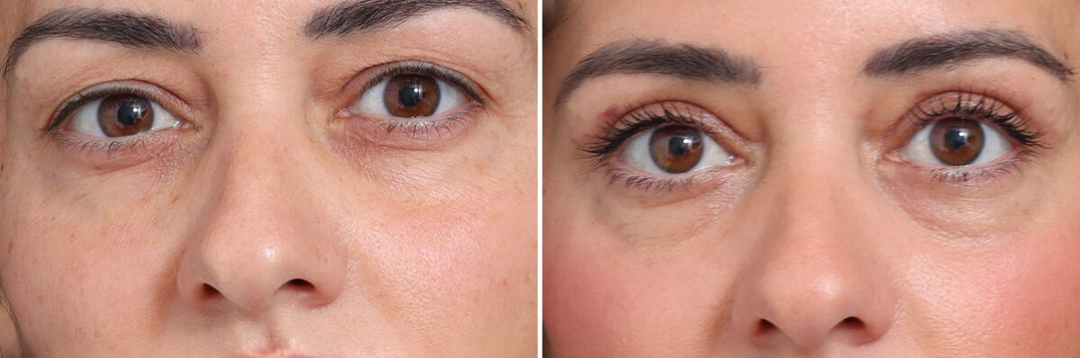 Upper Eyelid Surgery Before and After Photos in Princeton, NJ, Patient 22230