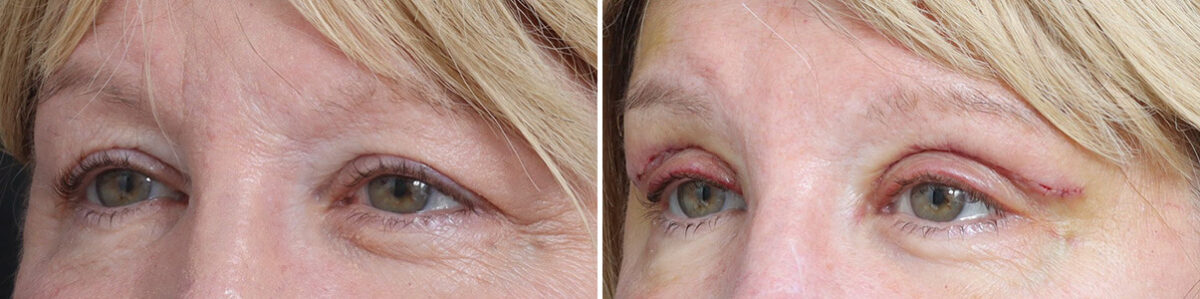 Upper Eyelid Surgery Before and After Photos in Princeton, NJ, Patient 22233