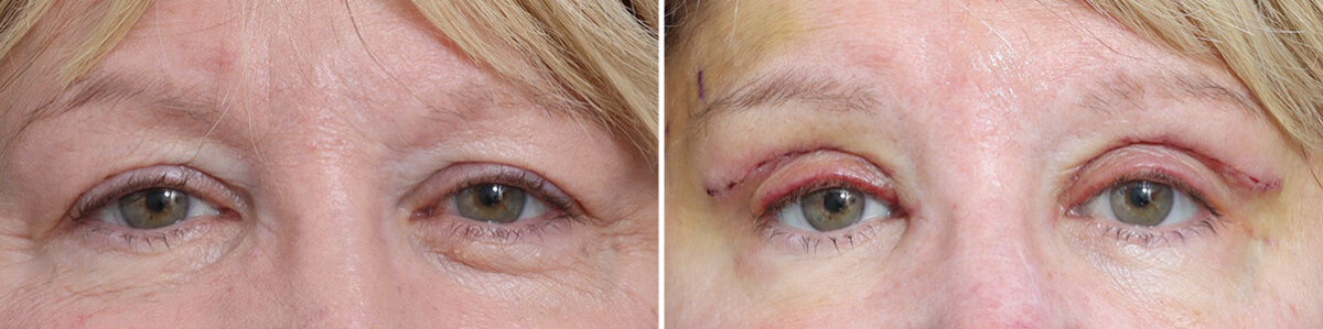 Upper Eyelid Surgery Before and After Photos in Princeton, NJ, Patient 22233