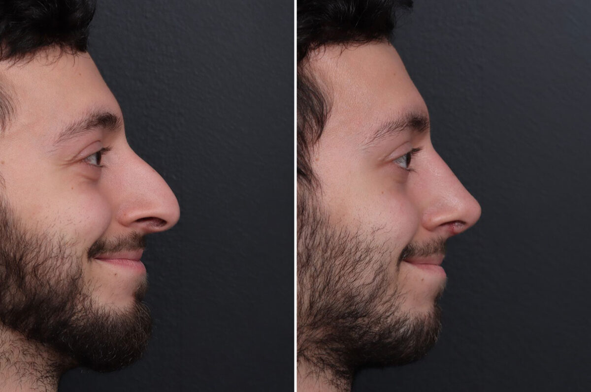 Rhinoplasty Before and After Photos in Princeton, NJ, Patient 22236