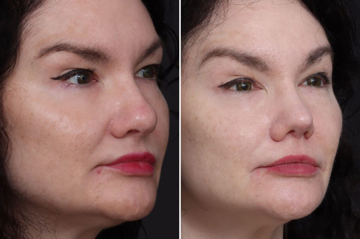 Rhinoplasty Before and After Photos in Princeton, NJ, Patient 22280