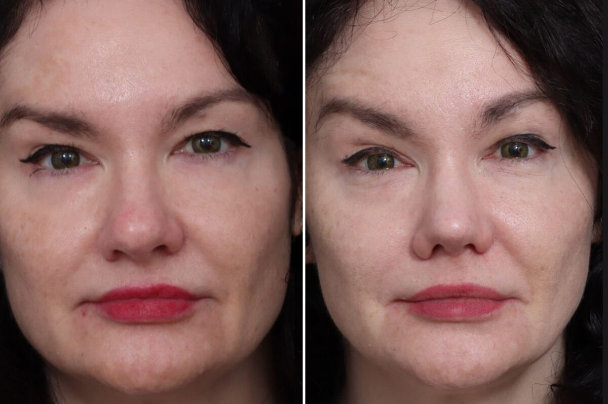 Rhinoplasty Before and After Photos in Princeton, NJ, Patient 22280