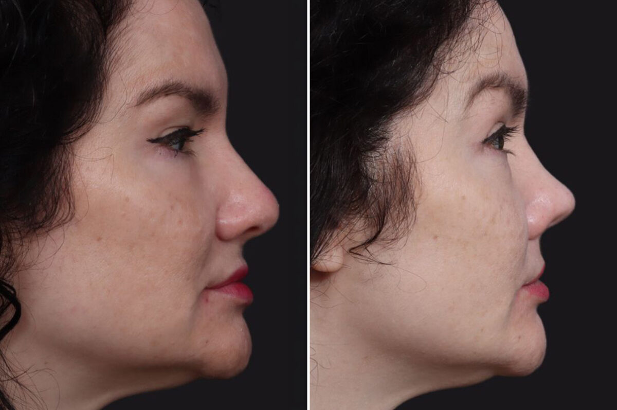 Rhinoplasty Before and After Photos in Princeton, NJ, Patient 22280