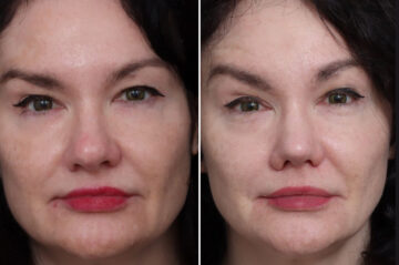 Rhinoplasty Before and After Photos in Princeton, NJ, Patient 22280