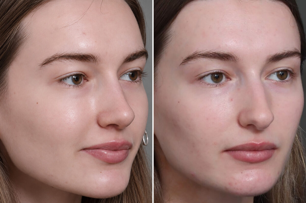 Rhinoplasty Before and After Photos in Princeton, NJ, Patient 22284