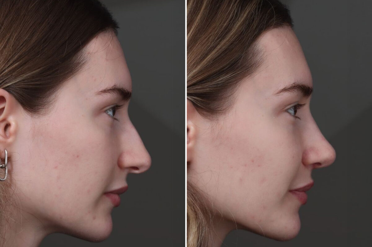 Rhinoplasty Before and After Photos in Princeton, NJ, Patient 22284