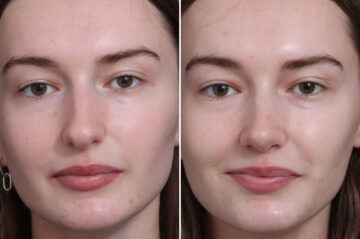 Rhinoplasty Before and After Photos in Princeton, NJ, Patient 22284