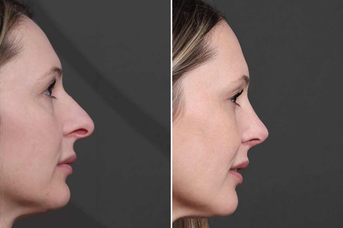 Rhinoplasty Before and After Photos in Princeton, NJ, Patient 22288