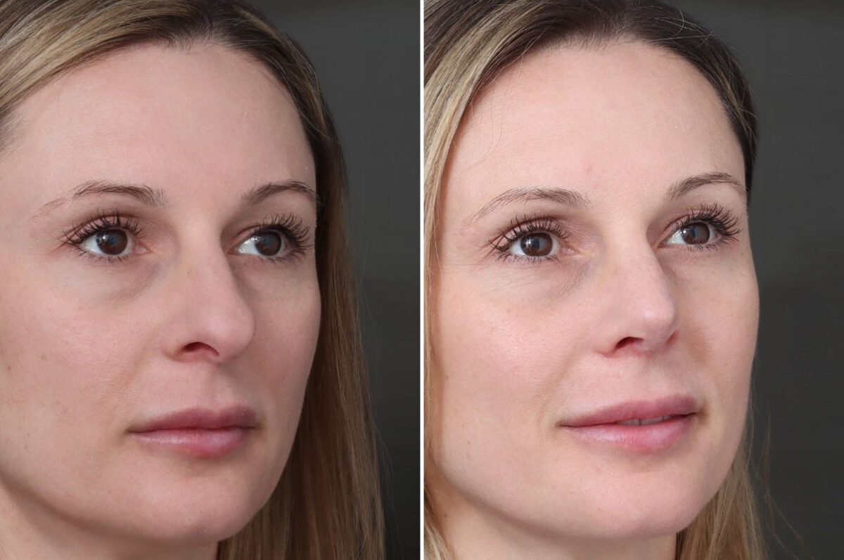 Rhinoplasty Before and After Photos in Princeton, NJ, Patient 22288