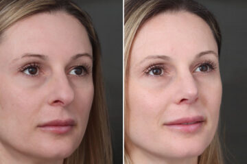 Rhinoplasty Before and After Photos in Princeton, NJ, Patient 22288