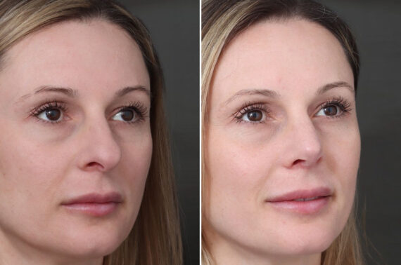 Rhinoplasty Before and After Photos in Princeton, NJ, Patient 22288