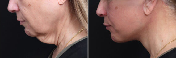 Deep Plane Facelift Before and After Photos in Princeton, NJ, Patient 22291