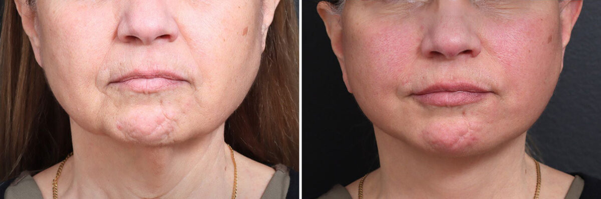 Deep Plane Facelift Before and After Photos in Princeton, NJ, Patient 22291