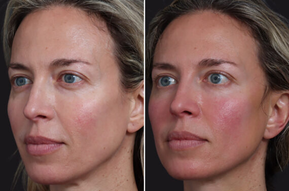 Microlift Before and After Photos in Princeton, NJ, Patient 22294