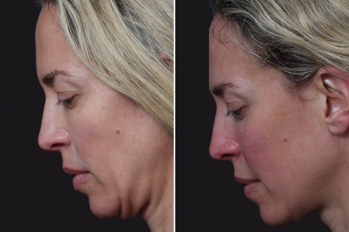 Microlift Before and After Photos in Princeton, NJ, Patient 22294
