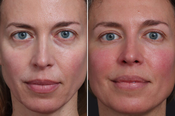 Microlift Before and After Photos in Princeton, NJ, Patient 22294