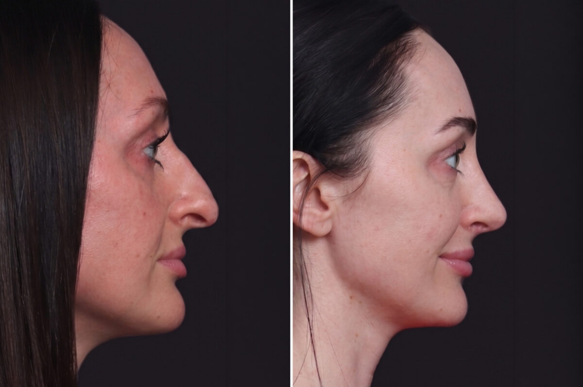 Rhinoplasty Before and After Photos in Princeton, NJ, Patient 22298