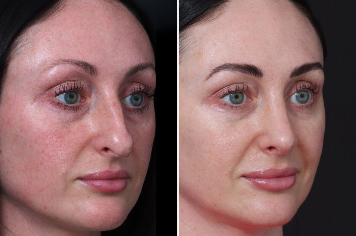 Rhinoplasty Before and After Photos in Princeton, NJ, Patient 22298