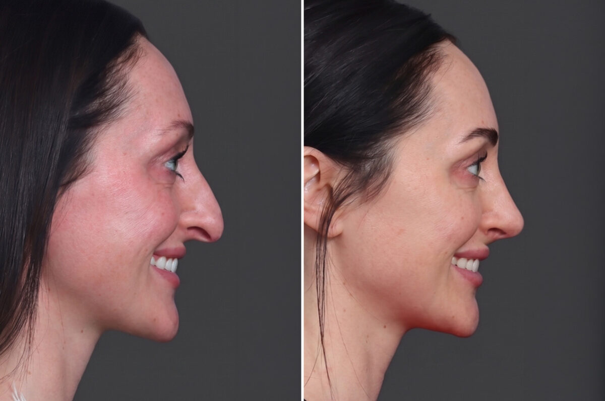 Rhinoplasty Before and After Photos in Princeton, NJ, Patient 22298