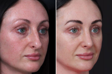 Rhinoplasty Before and After Photos in Princeton, NJ, Patient 22298