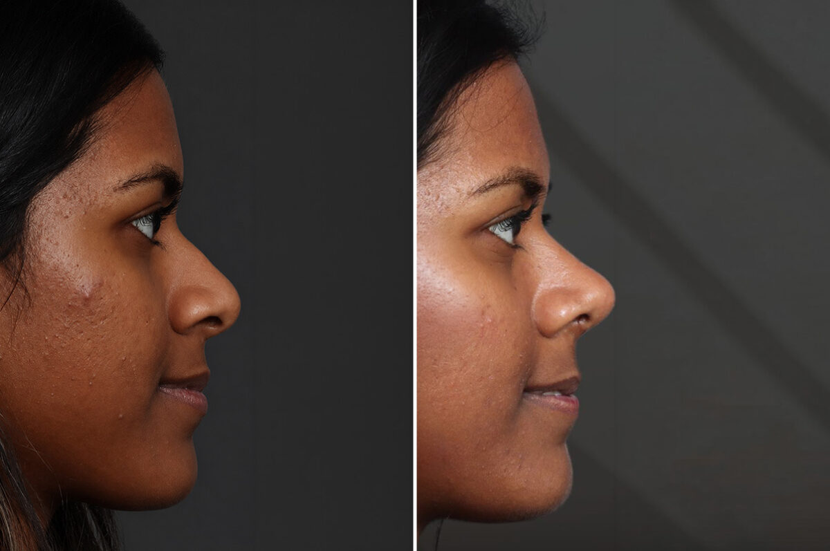 Rhinoplasty Before and After Photos in Princeton, NJ, Patient 22302