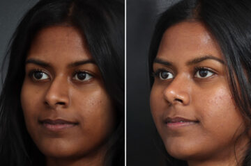 Rhinoplasty Before and After Photos in Princeton, NJ, Patient 22302